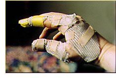 Metal mesh taped to hand.
