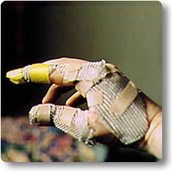 The inner framework Hand protected by mesh